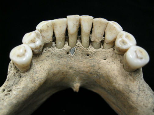 Dental calculus on the lower jaw a medieval woman entrapped lapis lazuli pigment. Photo credit: Christina Warinner
